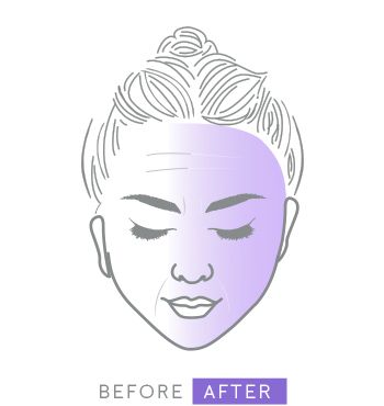 Ein illustriertes Gesicht einer Frau zeigt die Vorher-Nachher-Wirkung bei Anwendung des Clinical Solutions Boosters Resveratrol Line Reducer.