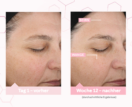 Vorher-nachher-Bilder von Tag 1 und Woche 12 zeigen die durchschnittliche Hautverbesserung an der Stirn nach der Anwendung des TimeWise® „Wunder-Set“