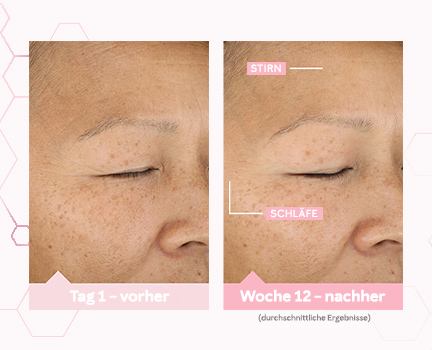 Vorher-nachher-Bilder von Tag 1 und Woche 12 zeigen die durchschnittliche Hautverbesserung an der  Schläfe nach der Anwendung des TimeWise® „Wunder-Set“
